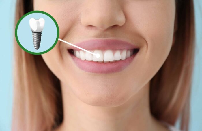 Dental Implants Dental Solutions of Mississippi dentist in Canton MS Dr. Ruth Roach Morgan Dr. Jessica
