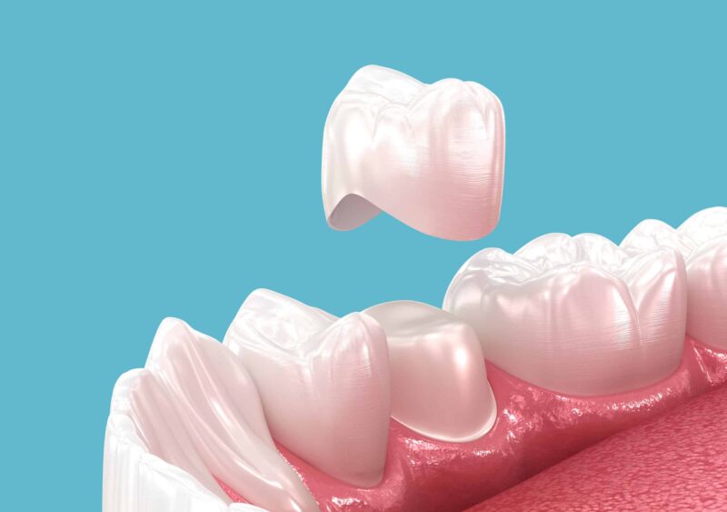 Same-Day Crowns in Canton